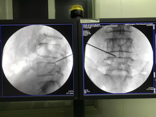 治疗腰椎间盘突出症，仅需7毫米！被誉为“毫米级技术”的椎间孔镜术给患者带来福音！