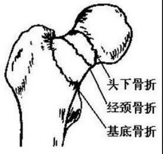 股骨颈骨折，骨不连会得股骨头坏死吗？该怎么办？